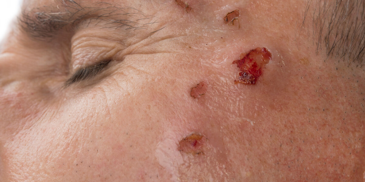Can Damaged Skin Heal After Meth Addiction?